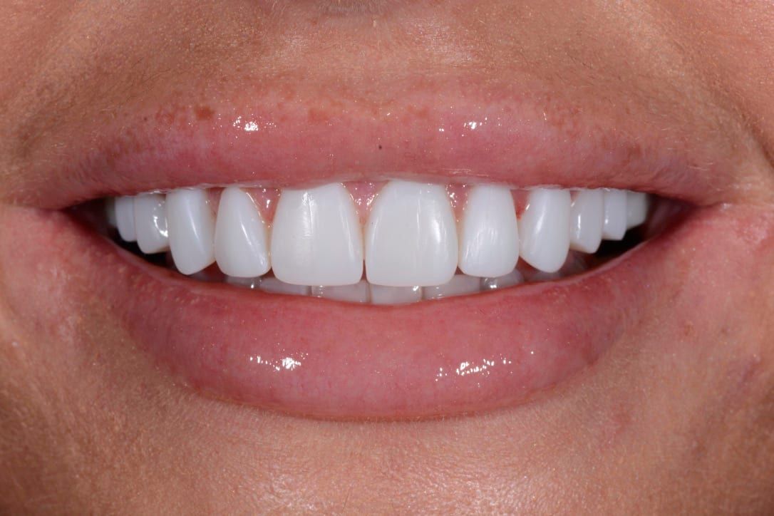 Patient after veneers