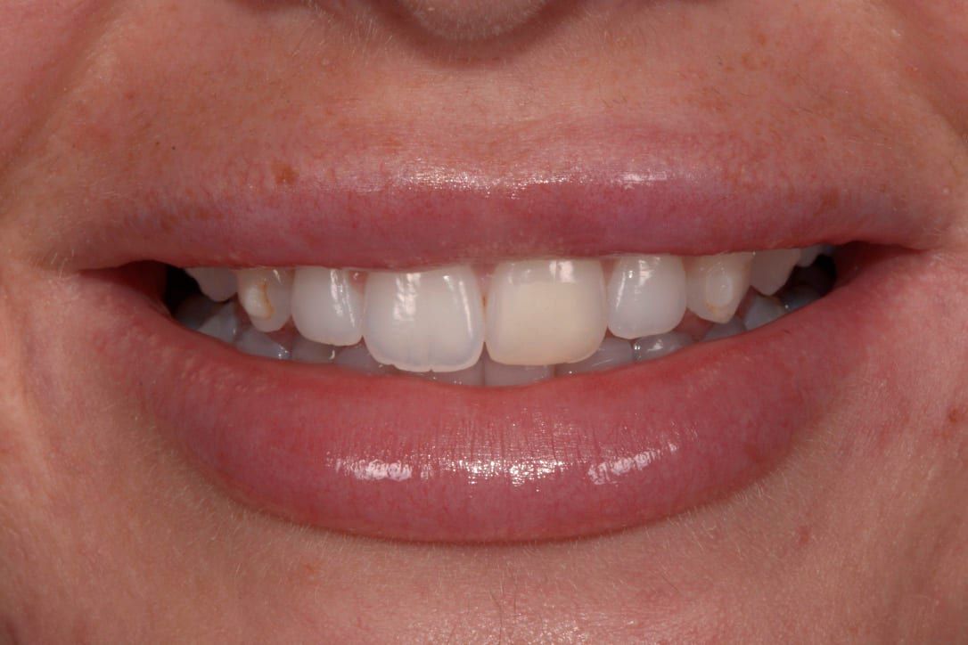 Patient before veneers