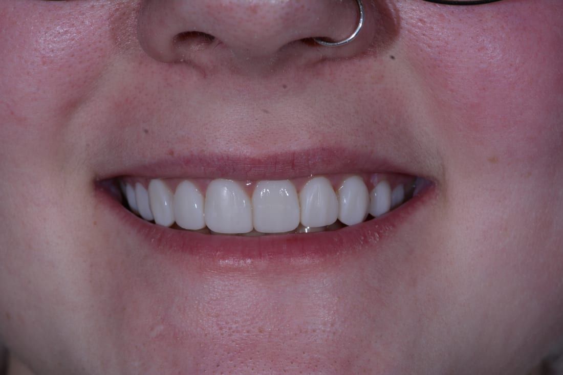 Daniel's smile after veneers