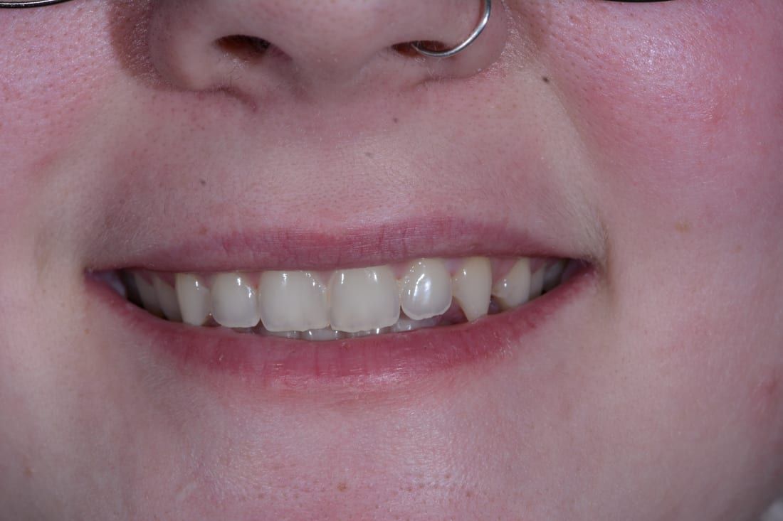 Daniel's smile before veneers