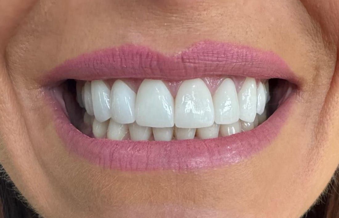 Aisha's smile after veneers