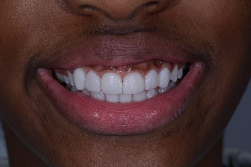 James's smile after veneers