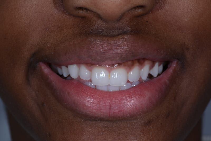 James's smile before veneers